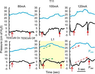 Transcutaneous Electrical Spinal Cord Neuromodulator (TESCoN) Improves Symptoms of Overactive Bladder
